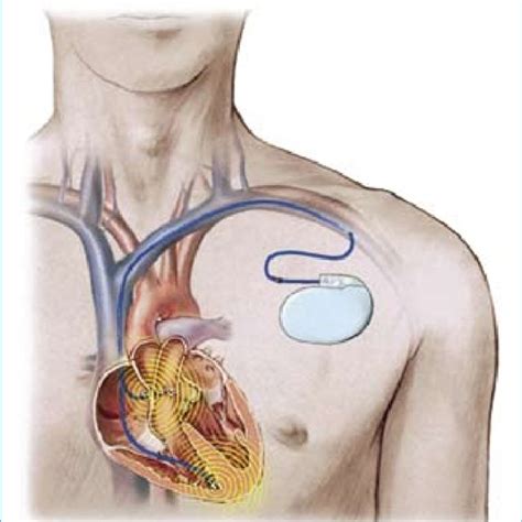 electromagnetic interference with pacemakers